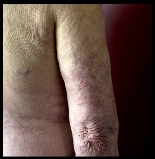 Burns suffered by Kevin Tveisme in BHO explosion - using Power butane