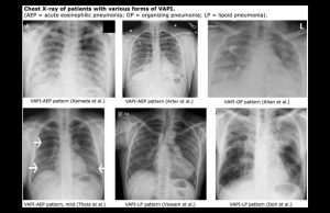 lung XRays of VAPI patients