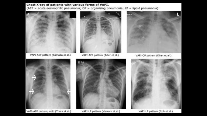 Alarming Health Effect Reports From Vaping Black Market Carts lung XRays of VAPI patients
